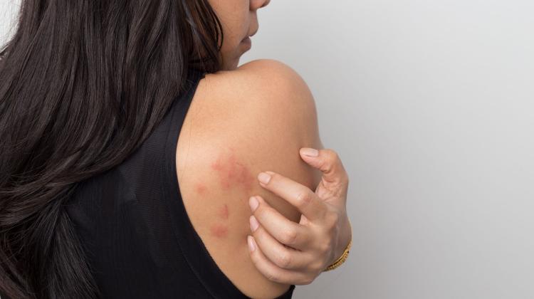 Ополе/USK разработал приложение для пациентов с симптомами крапивницы