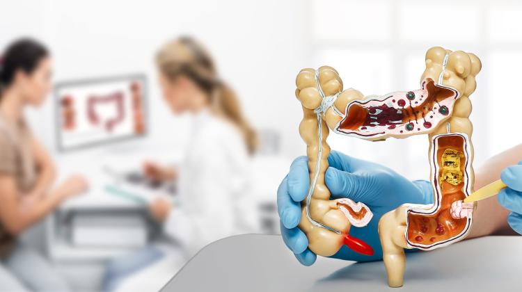 Национальный фонд здравоохранения: ежегодно около 18 000 человек диагностируют колоректальный рак. люди в Польше