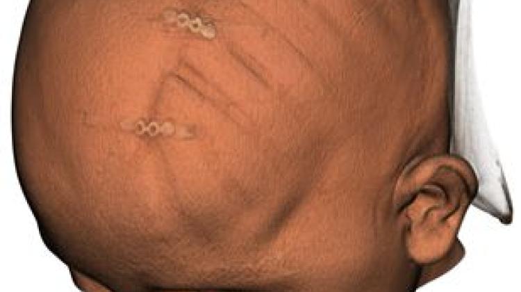 Польская медицинская 3D-печать помогла украинским детям