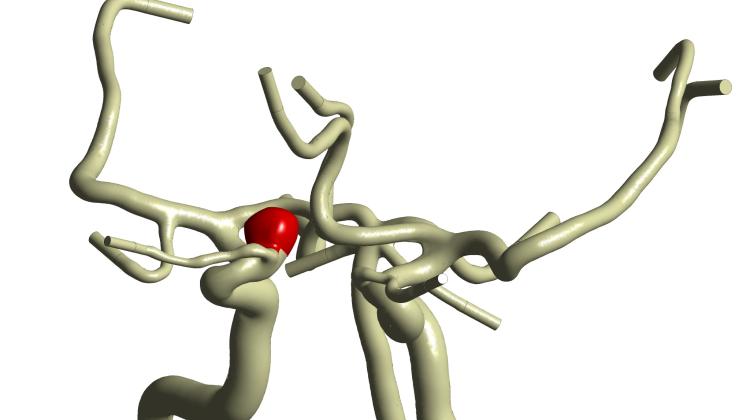 Программное обеспечение поможет нейрохирургам в лечении аневризм