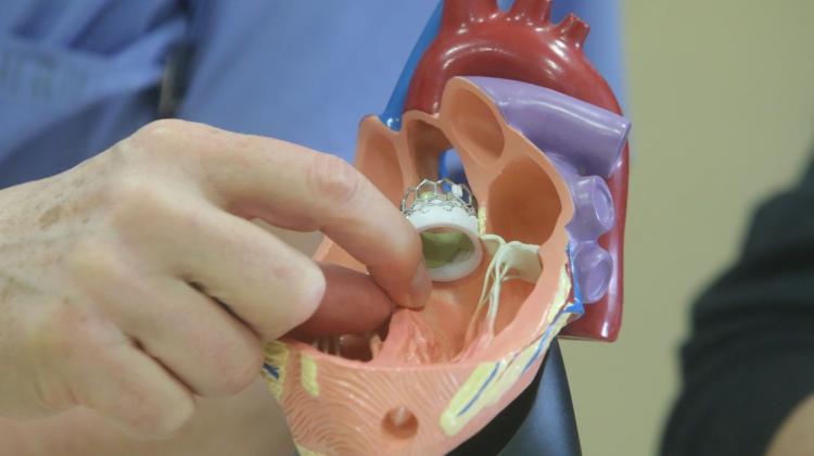 Белосток/ Улучшение качества жизни пациента с гипертрофической кардиомиопатией после уникальной операции на сердце