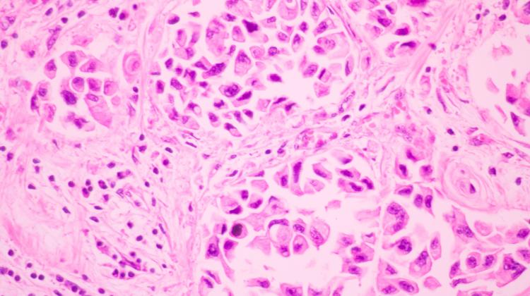 Физики создали модель риска рака у женщин