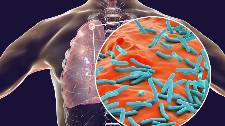 Эксперты: в 2023 году в Польше зарегистрирован 4231 случай туберкулеза