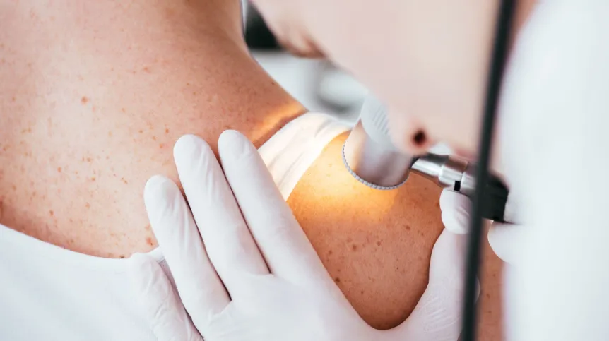 Эксперты: число случаев меланомы за последнее десятилетие увеличилось почти вдвое