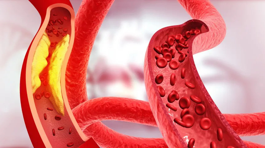Забже/ 15 процентов обследованных детей имеют нарушения липидного обмена